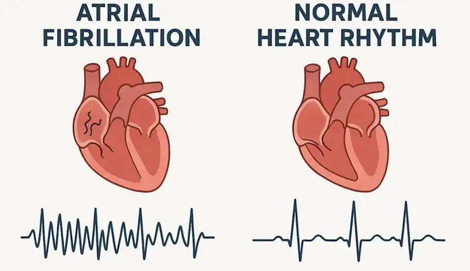 Normal heart rhythm vs Atrial Fibrillation comparison