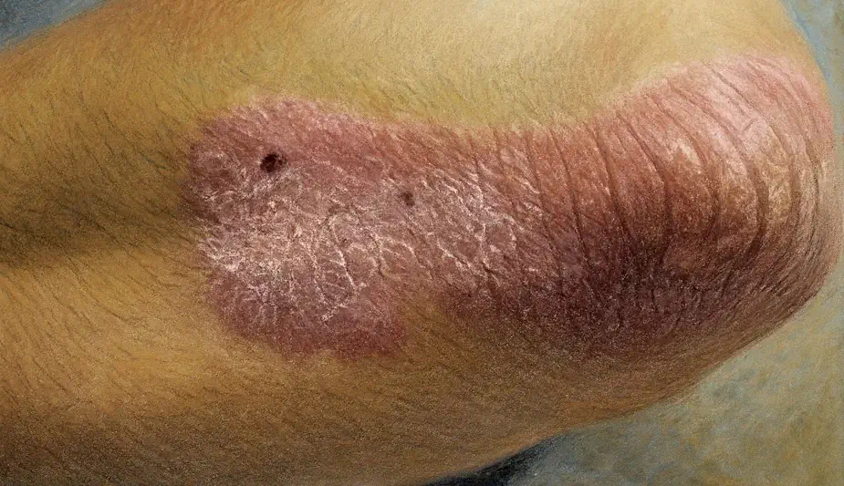 Close-up of plaque psoriasis on a patient's elbow, illustrating silvery scales and inflammation.
